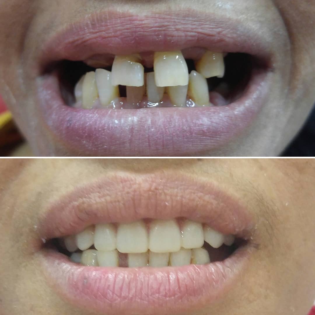 klinik dental implant surabaya