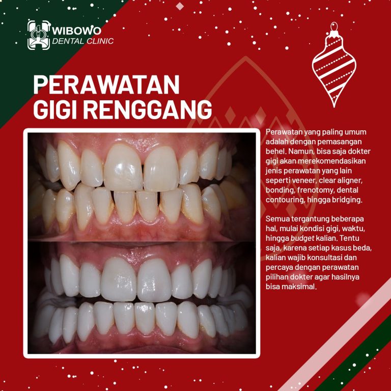 Gigi Renggang