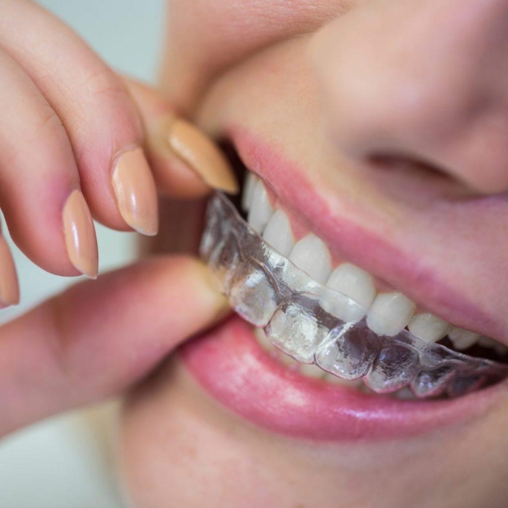 clear aligner