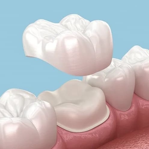 Crown Gigi, Pastikan Ditangani Dokter yang Kompeten