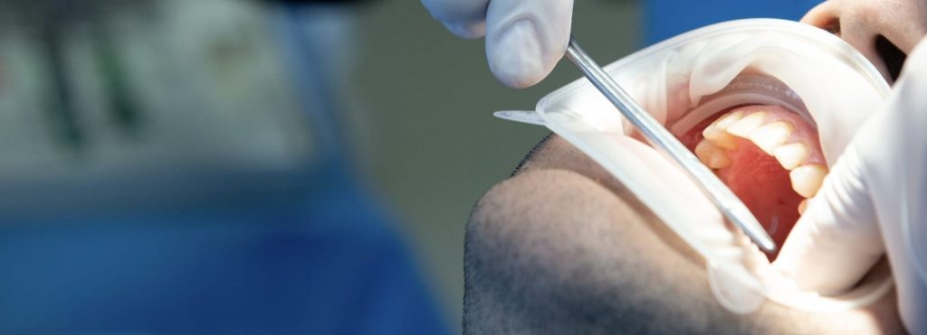 operasi gigi geraham surabaya