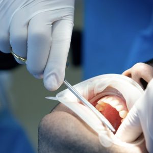 operasi gigi geraham