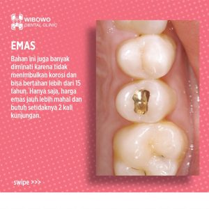 Tambalan Gigi Emas 