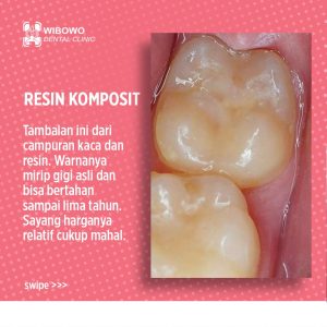 Tambalan GIgi Resin Komposit
