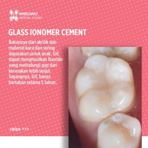 Tambalan gigi glass ionomer cement