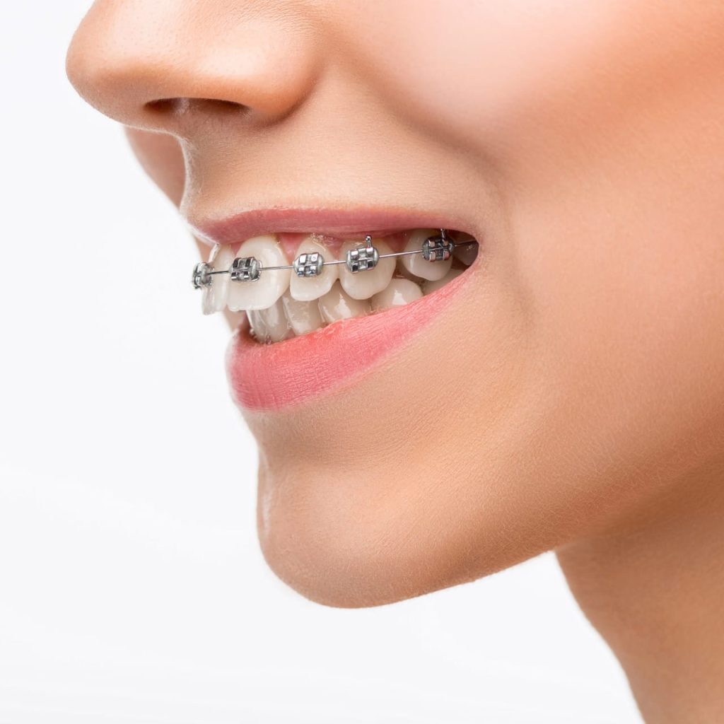 Harga Pasang Behel