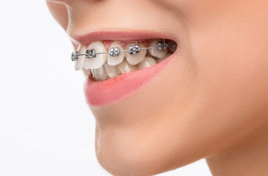 Harga Pasang Behel