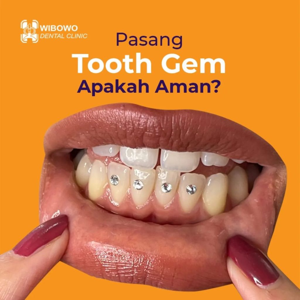 pasang tooth gems
