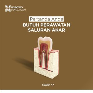 perawatan saluran akar gigi