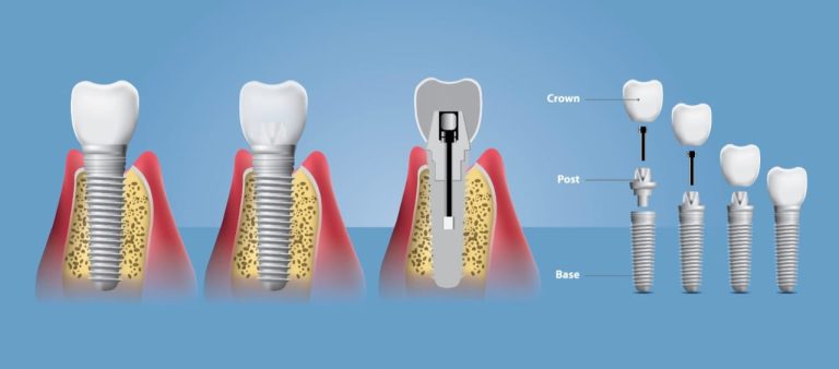 harga tanam gigi permanen
