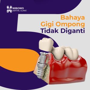 gigi ompong