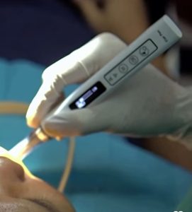 Computerd Controled Dental Injection