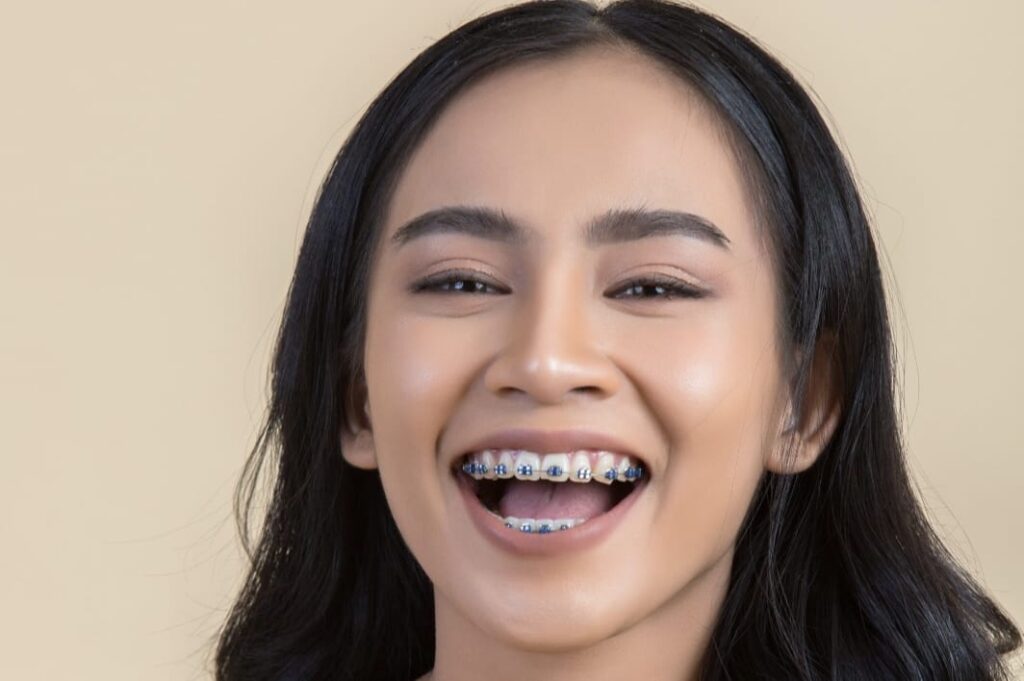 biaya pasang kawat gigi