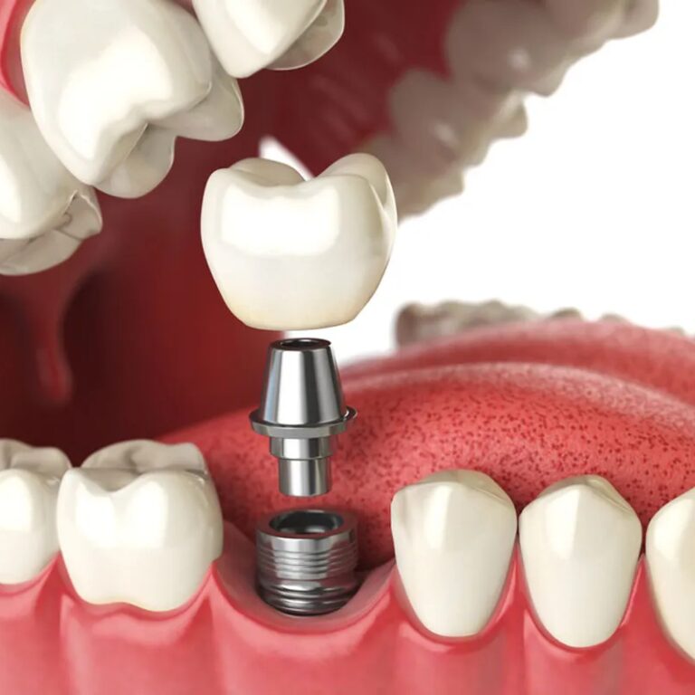 implan gigi