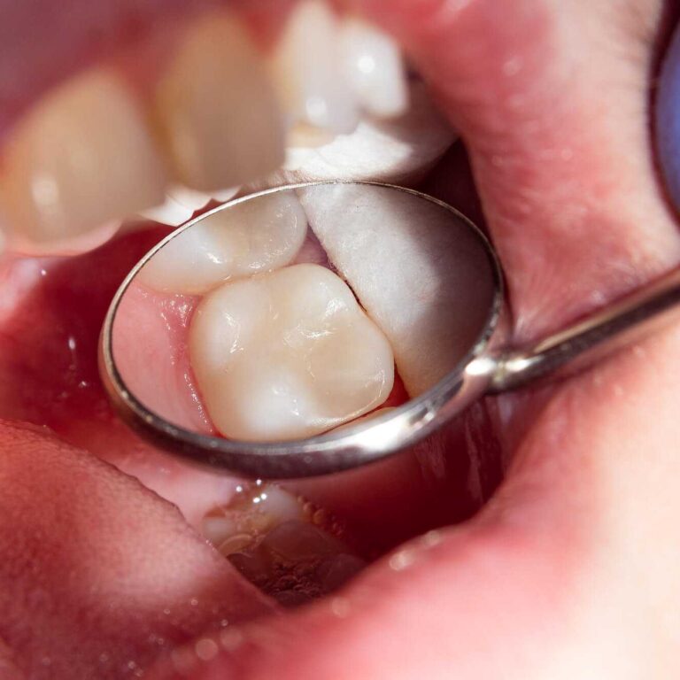 Gigi Sudah Ditambal tapi Masih Sakit