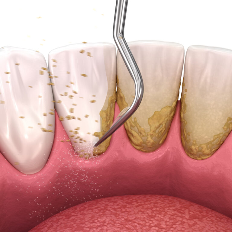 Gigi Sensitif Setelah Scaling