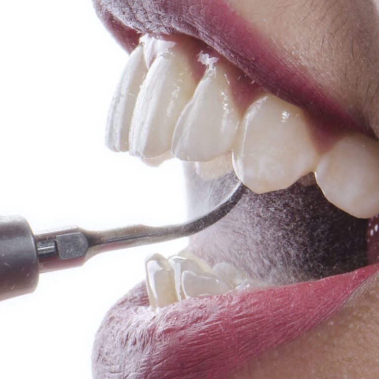 Biaya Scaling Gigi Surabaya