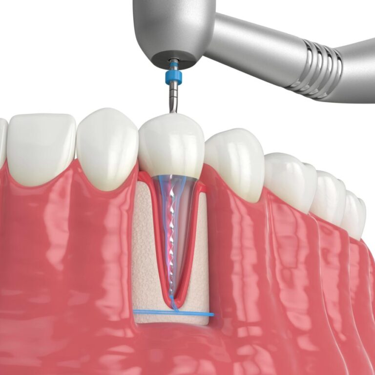 Infeksi Saluran Akar Gigi
