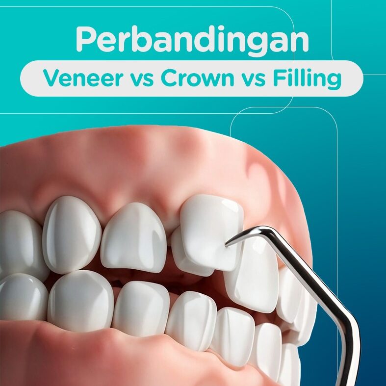 Veneer Crown Filling