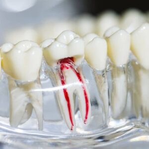 Perawatan Saluran Akar