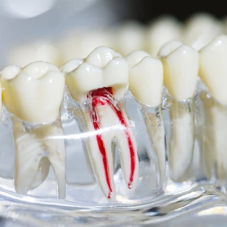 Perawatan Saluran Akar