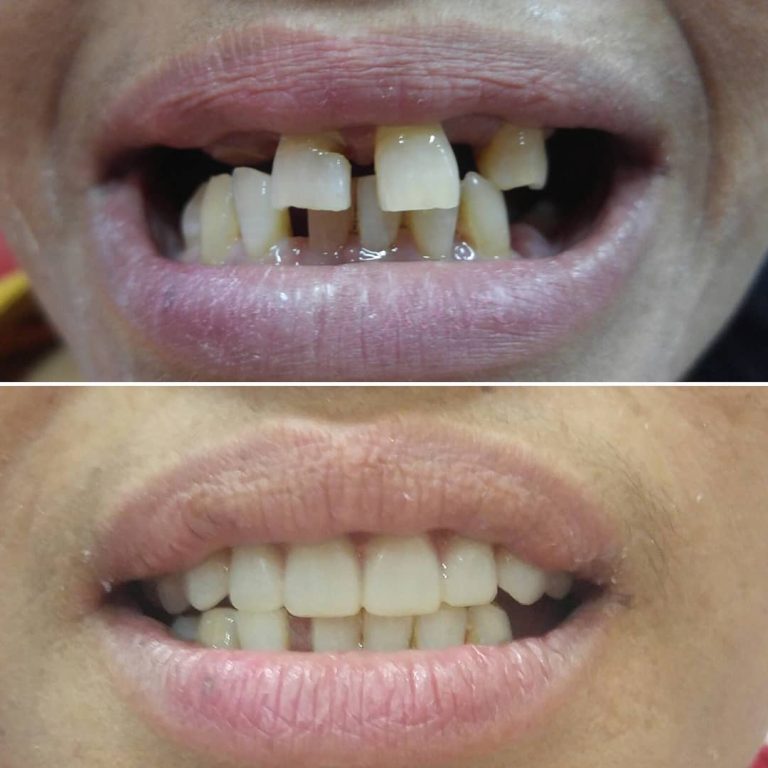 klinik dental implant surabaya