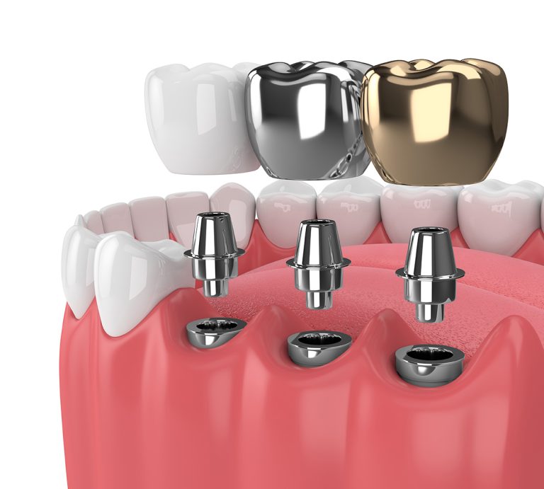 biaya dental implant