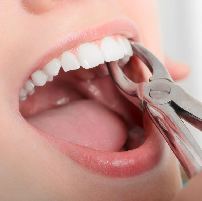 Gigi Berlubang Parah