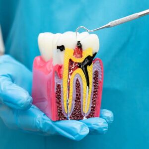 Biaya Perawatan Saluran Akar