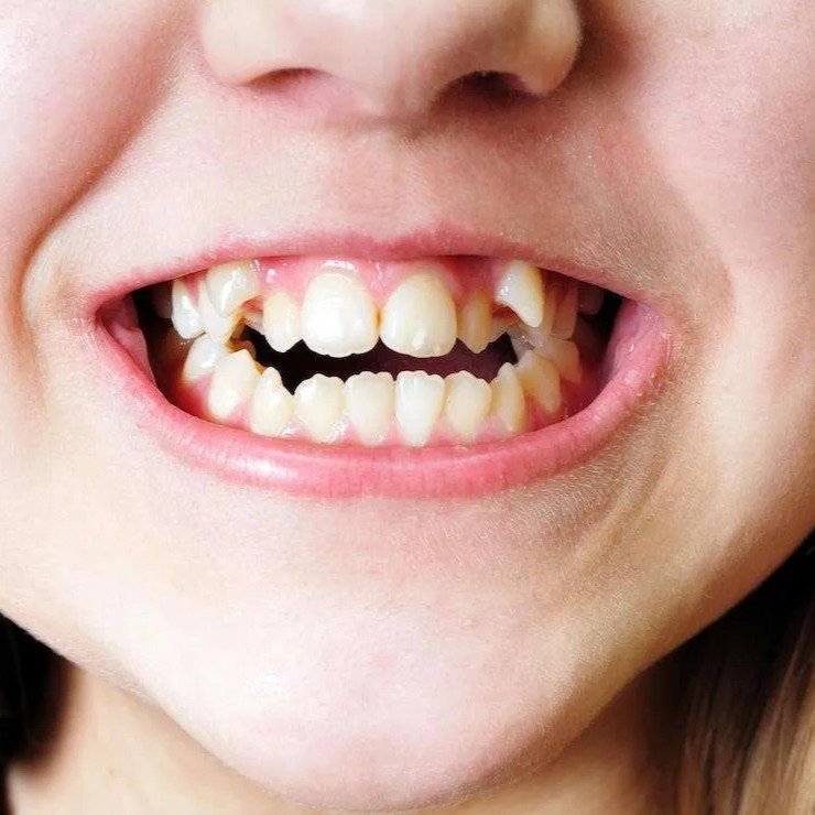 merapikan gigi gingsul