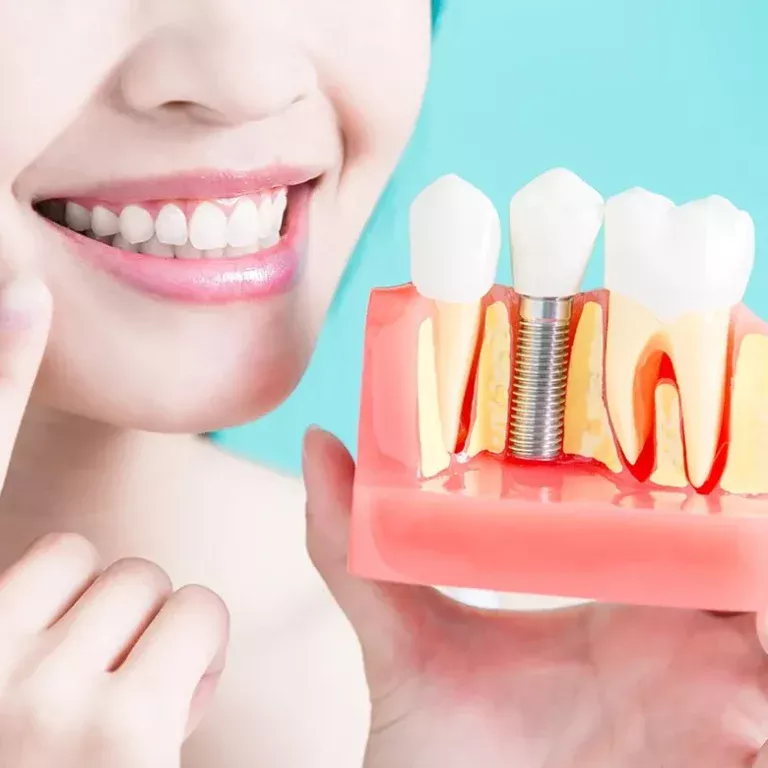 Jenis Implan Gigi