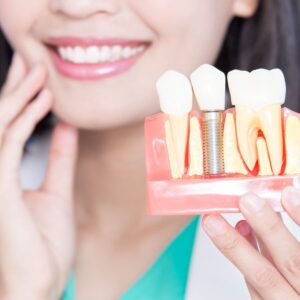 Implan Gigi Lepas