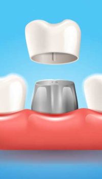 dental-crown.jpg